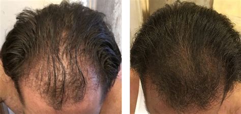 finasteride timeline results.